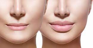 Youthful Alteration: Dermal Fillers within the Coronary heart of Santa Barbara